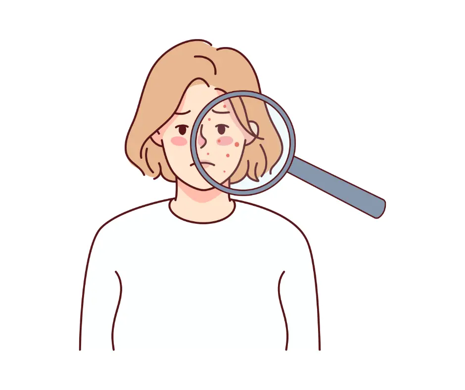 ニキビって何？