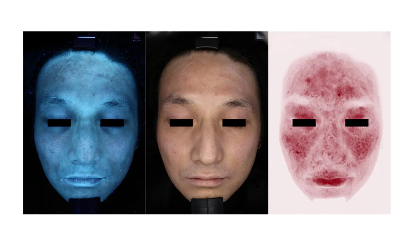 re-Beau2による肌診断