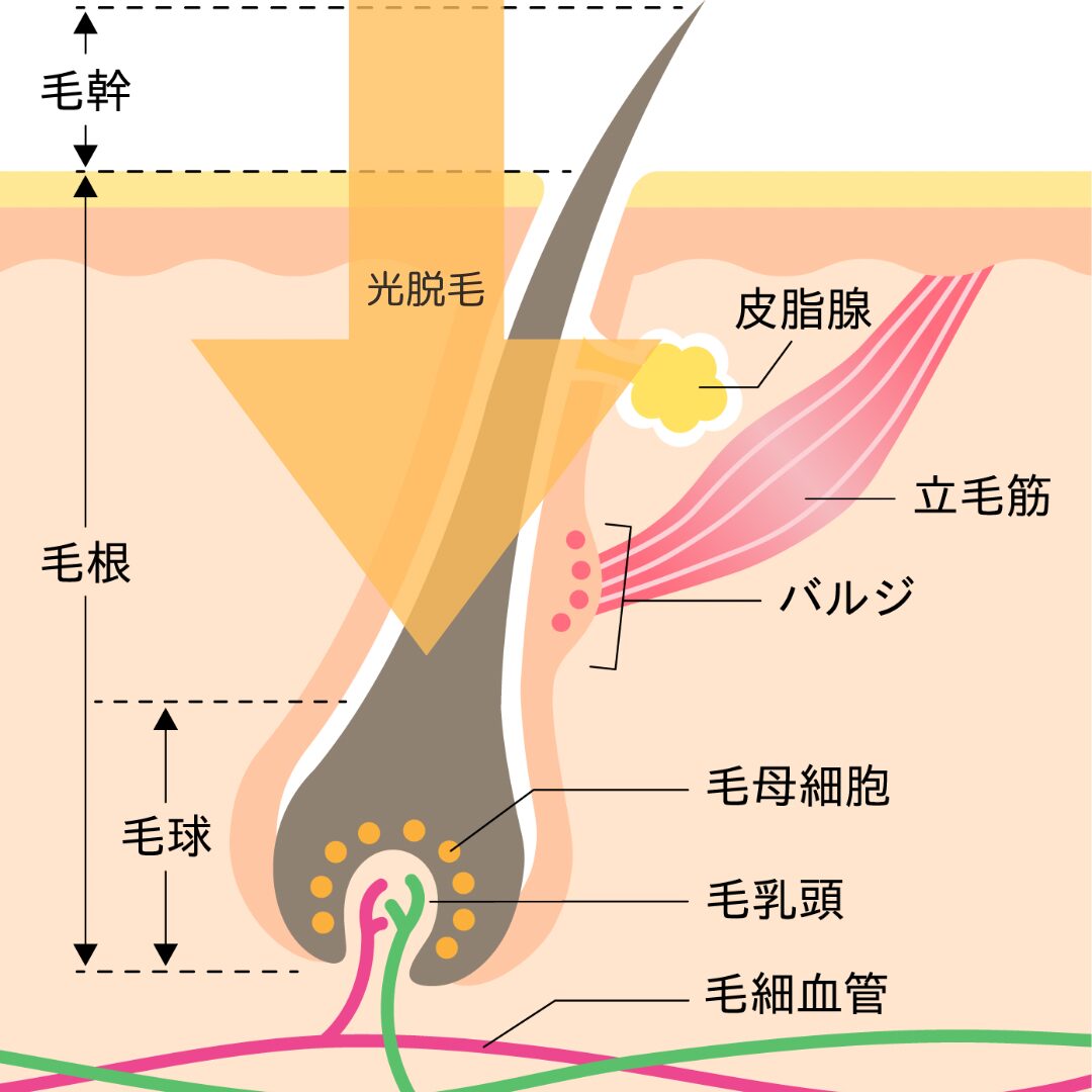 光脱毛と医療レーザー脱毛の違いまとめ - 天神ホリスティック